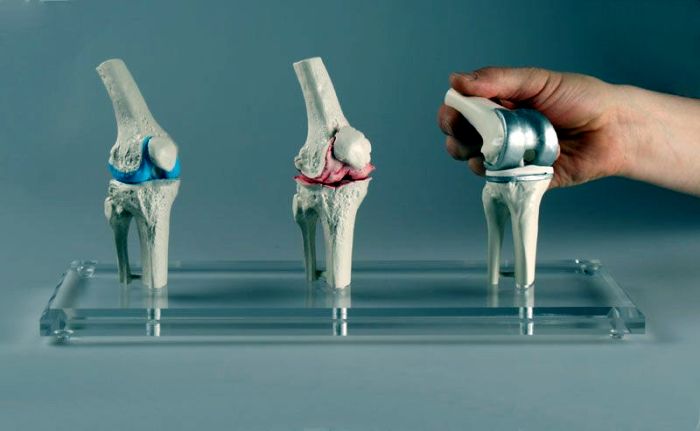 Knie-Implantat-Modell, Bestellnummer 1125