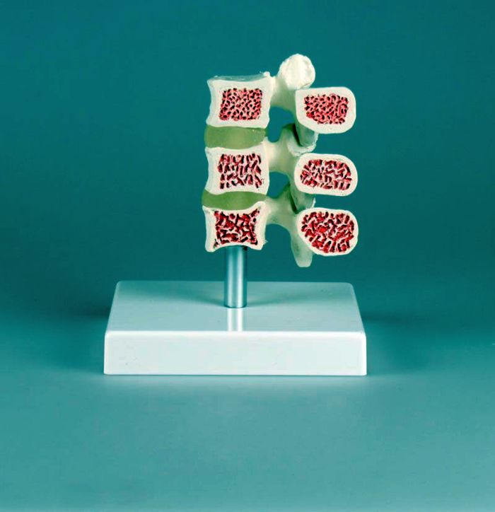 Osteoporose-Wirbel-Modell, 3 Wirbel, Bestellnummer 4078