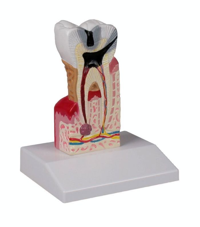 Zahnkariesmodell, 10-fache Größe, Bestellnummer D214
