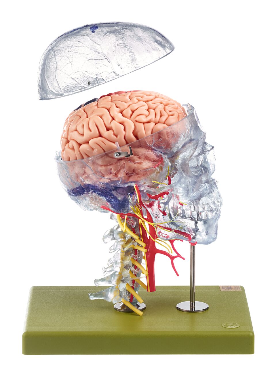 Hypertonie Pathologisches Modell inkl Gehirn Augen Herz Niere und Arterie 