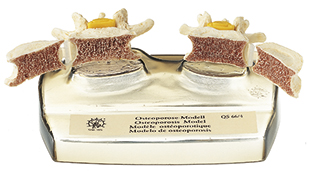 Osteoporose-Modell, Bestellnummer QS 66/4