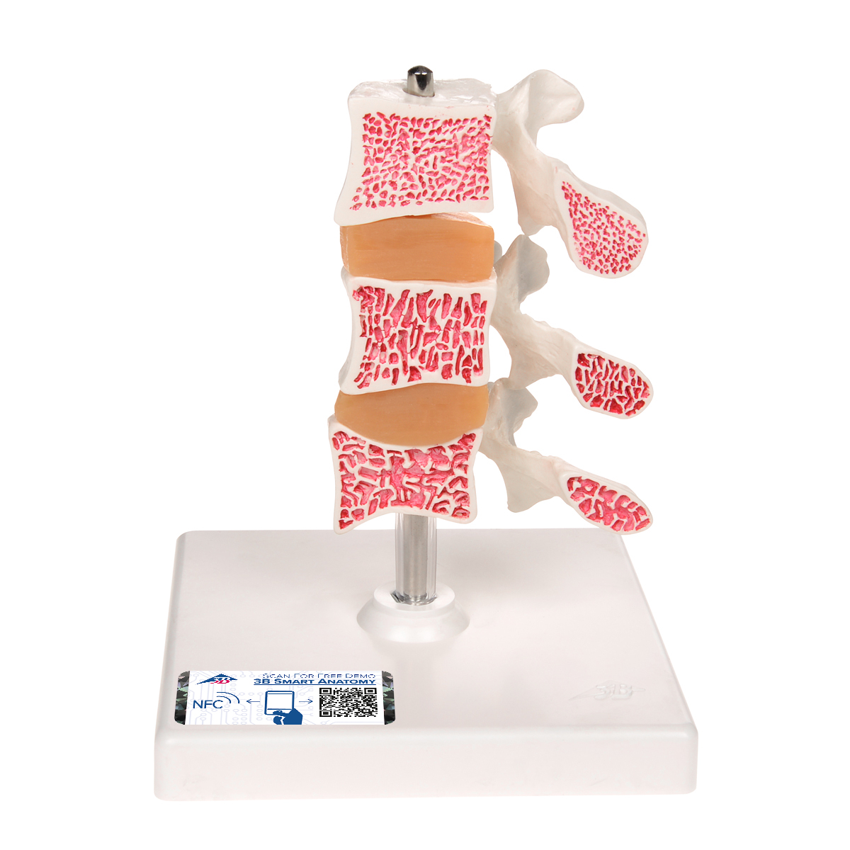 Osteoporose Modell mit 3 Lendenwirbeln, auf Stativ - 3B Smart Anatomy, Bestellnummer 1000153, A78, 3B Scientific