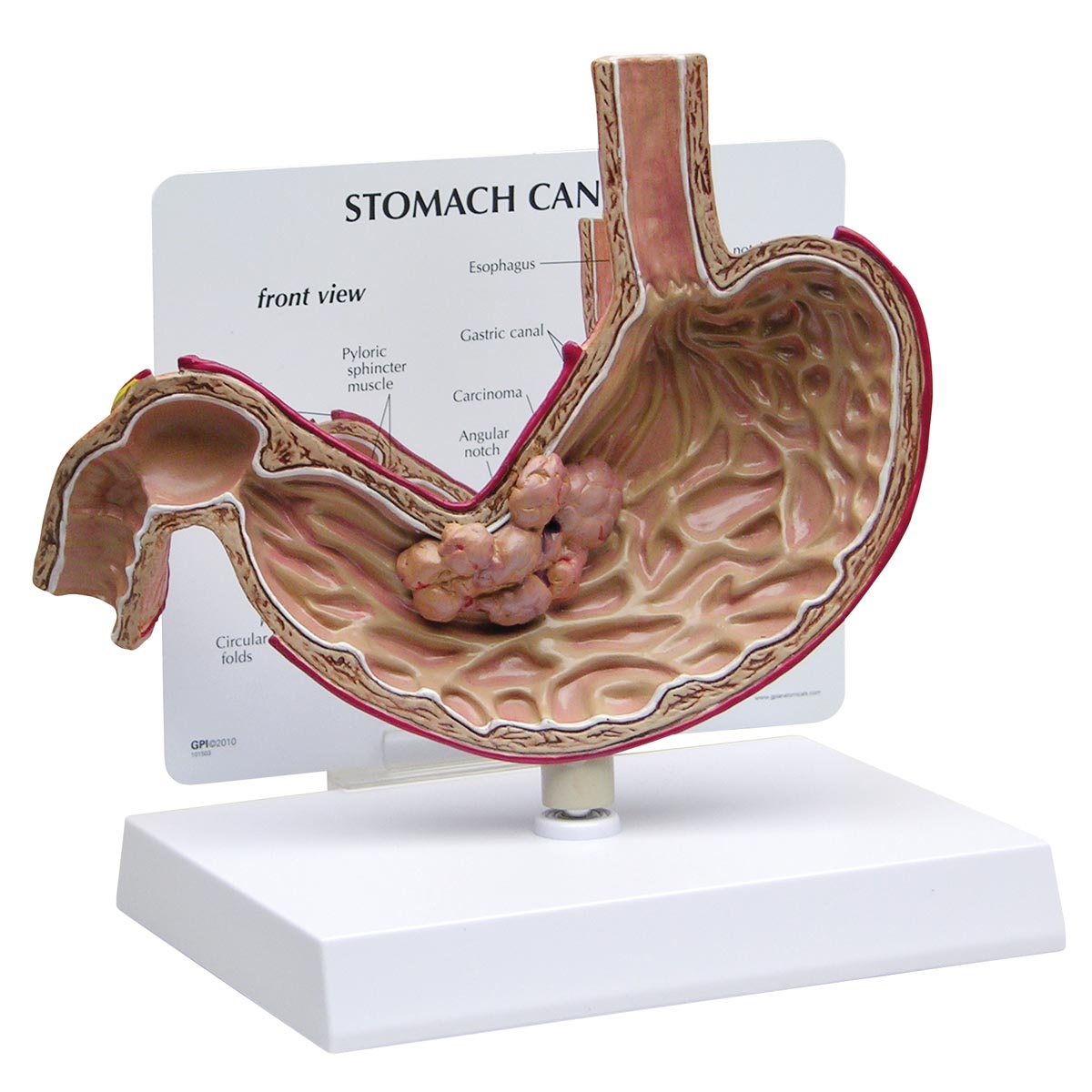 Magenkrebsmodell, Bestellnummer 1019524, 2001, GPI Anatomicals