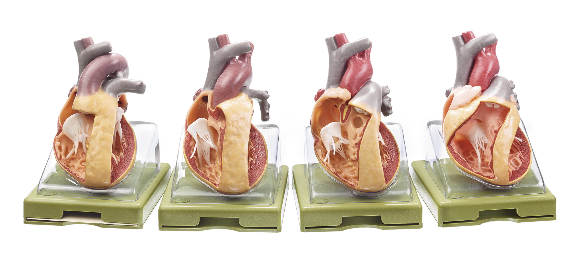 Modellserie mit der Darstellung angeborener Herzfehler, Bestellnummer OS 7, SOMSO-Modelle
