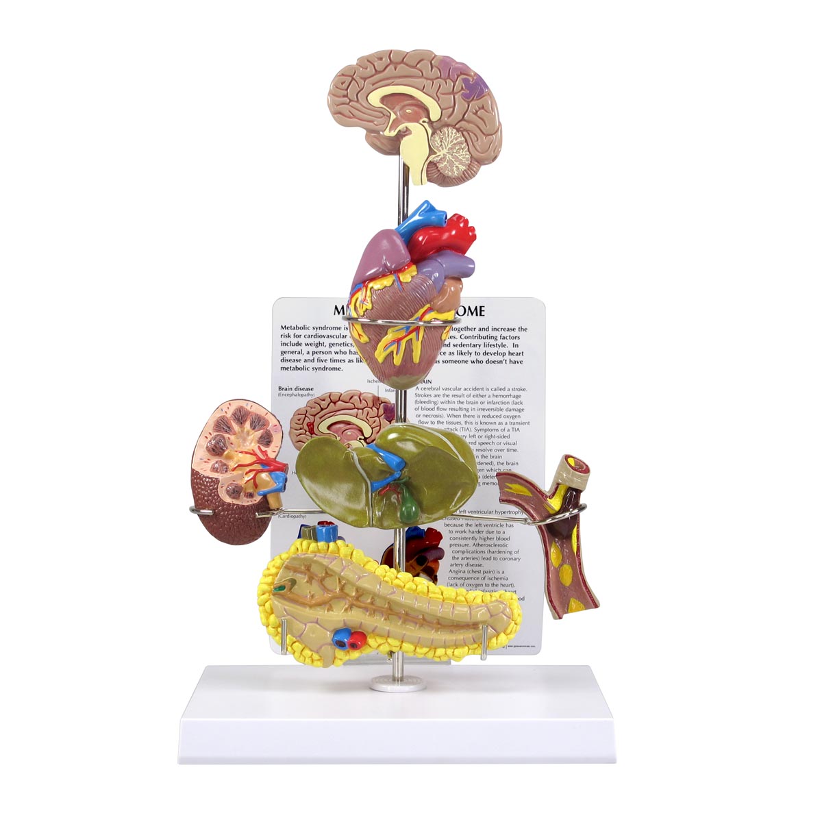 Modell eines metabolischen Syndroms, Bestellnummer 1019575, 4020, GPI Anatomicals