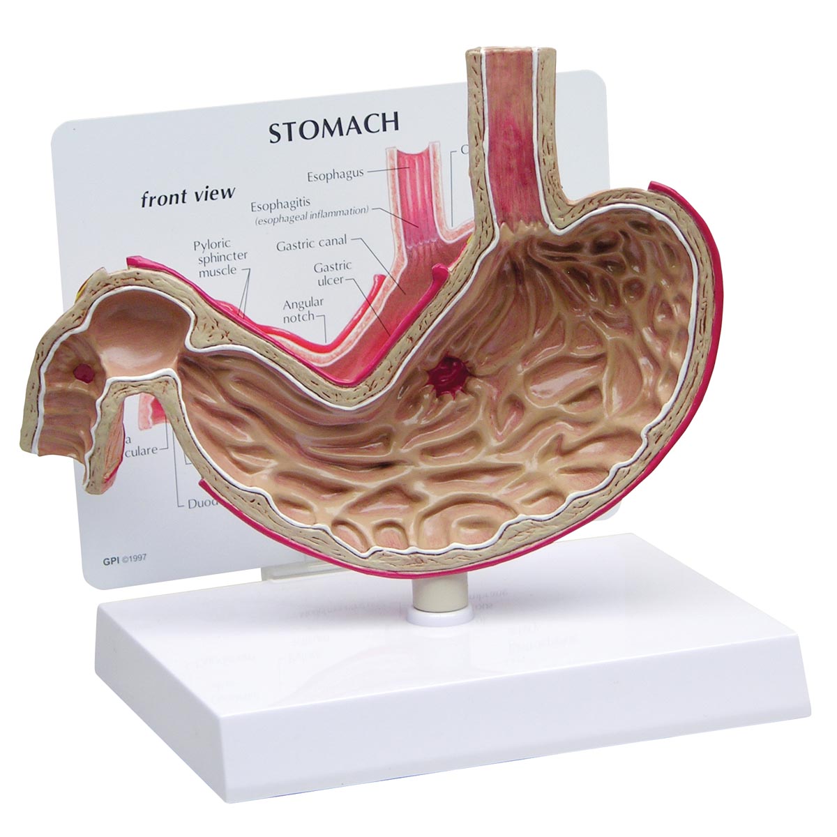 Magenmodell mit Geschwüren, Bestellnummer 1019523, 2000, GPI Anatomicals