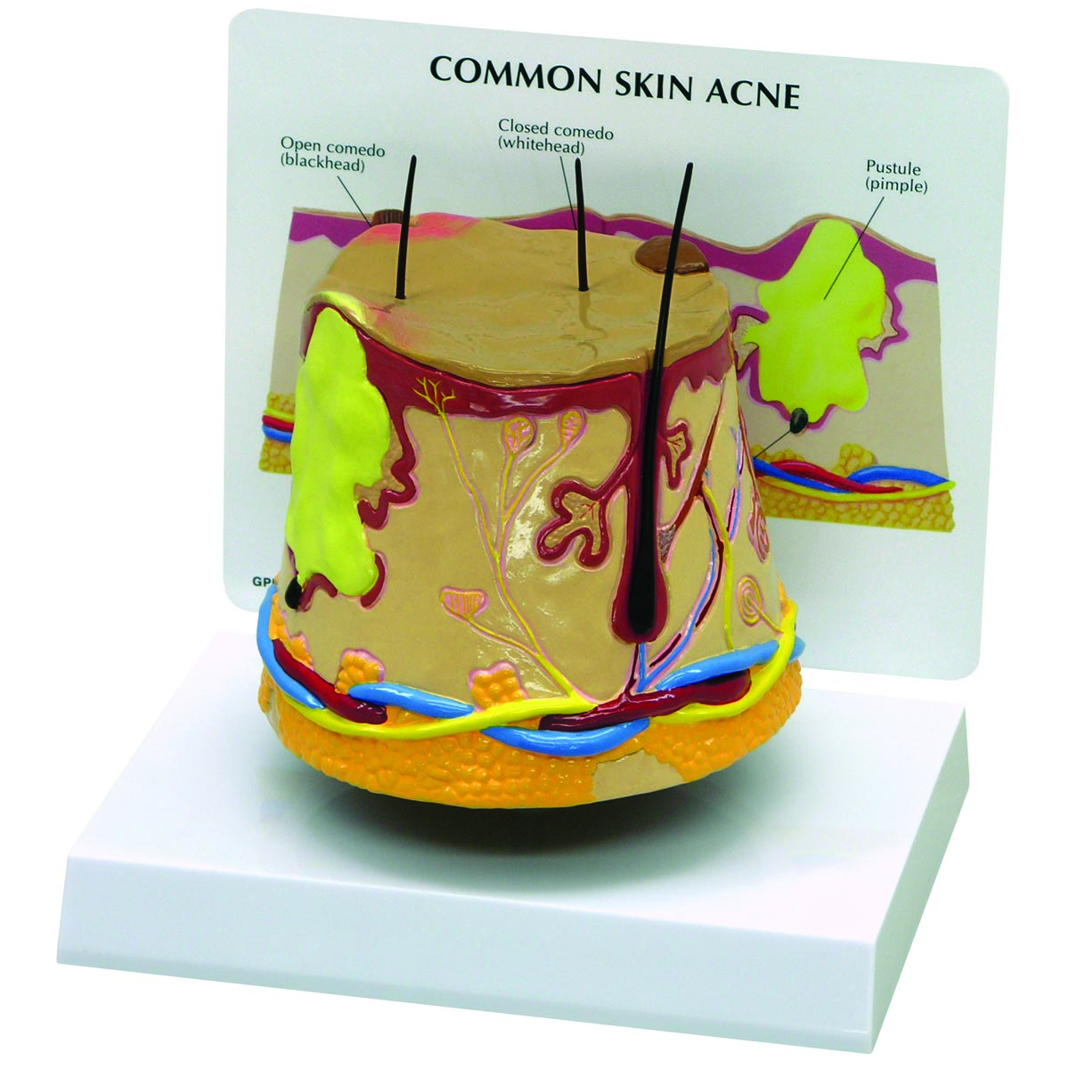 Modell einer Hautakne (überdimensioniert), Bestellnummer 1019567, 3750, GPI Anatomicals