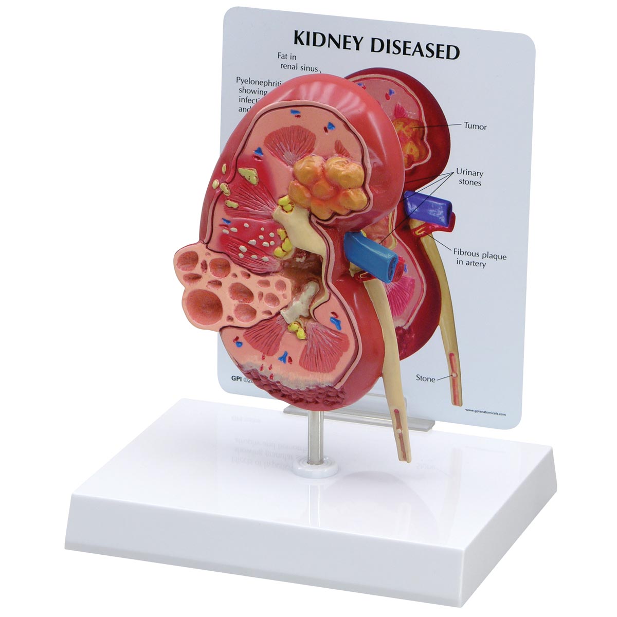 Modell einer erkrankten Niere, Bestellnummer 1019550, 3260, GPI Anatomicals