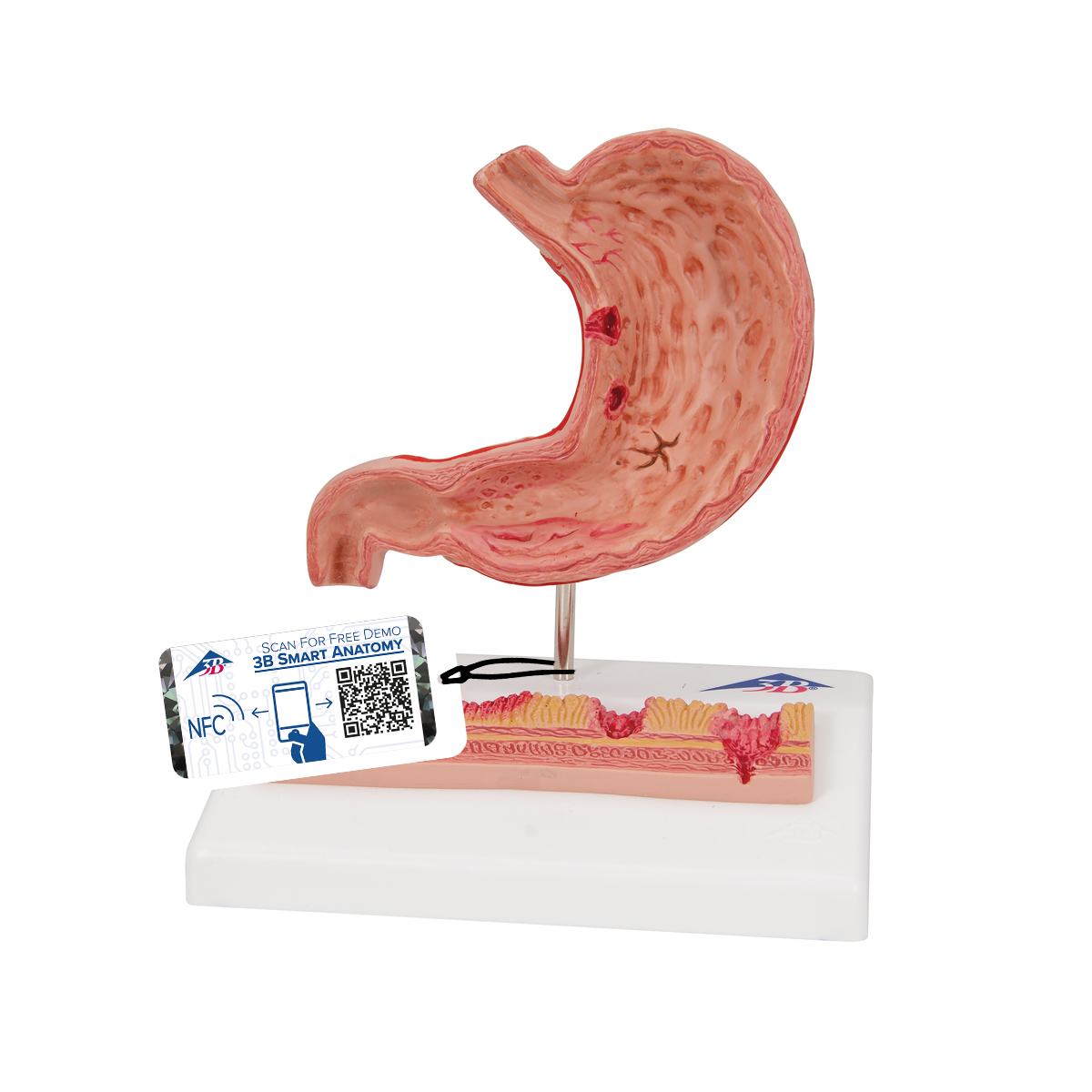 Magenmodell mit Magengeschwüren - 3B Smart Anatomy, Bestellnummer 1000304, K17, 3B Scientific