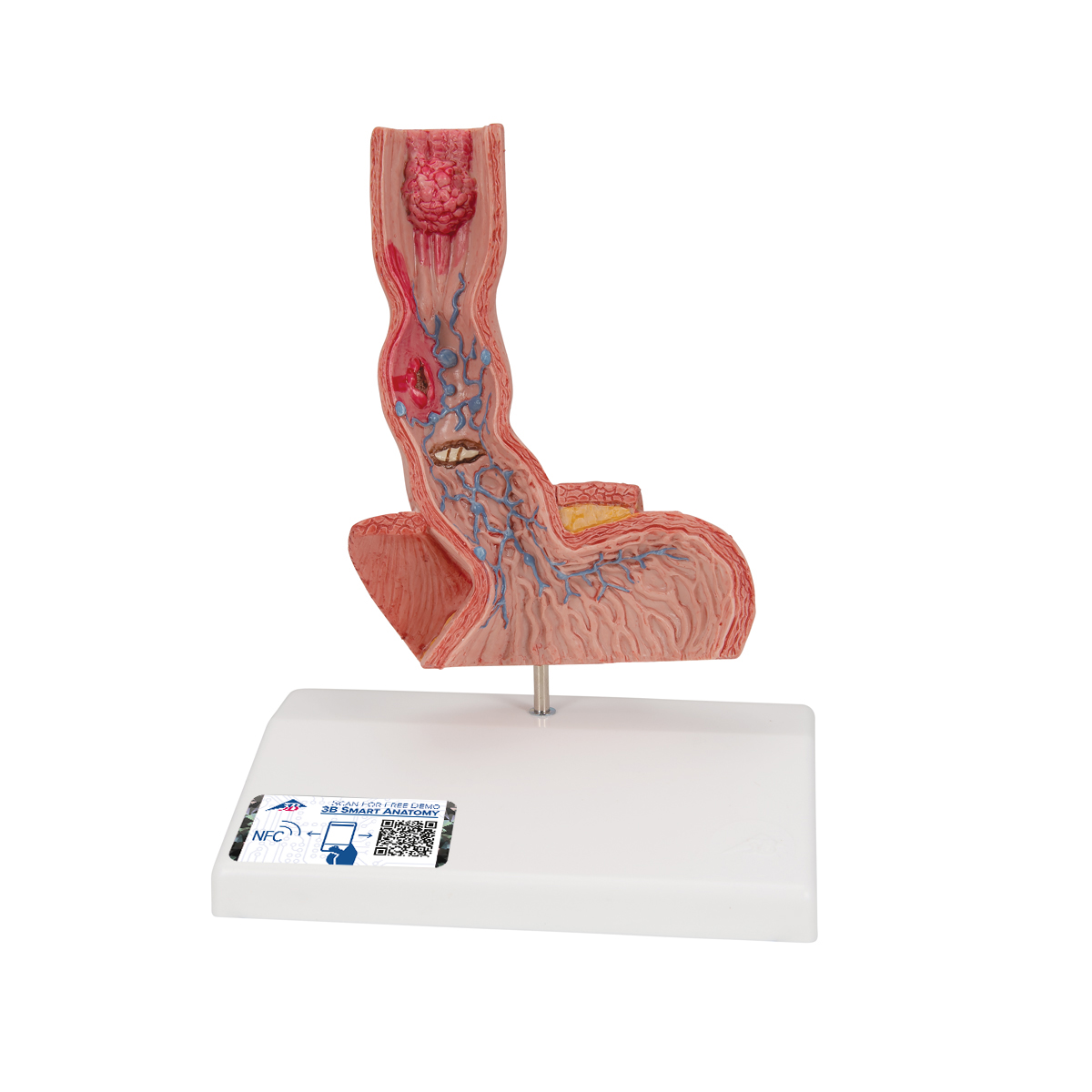 Pathologisches Modell der Speiseröhre - 3B Smart Anatomy, Bestellnummer 1000305, K18, 3B Scientific