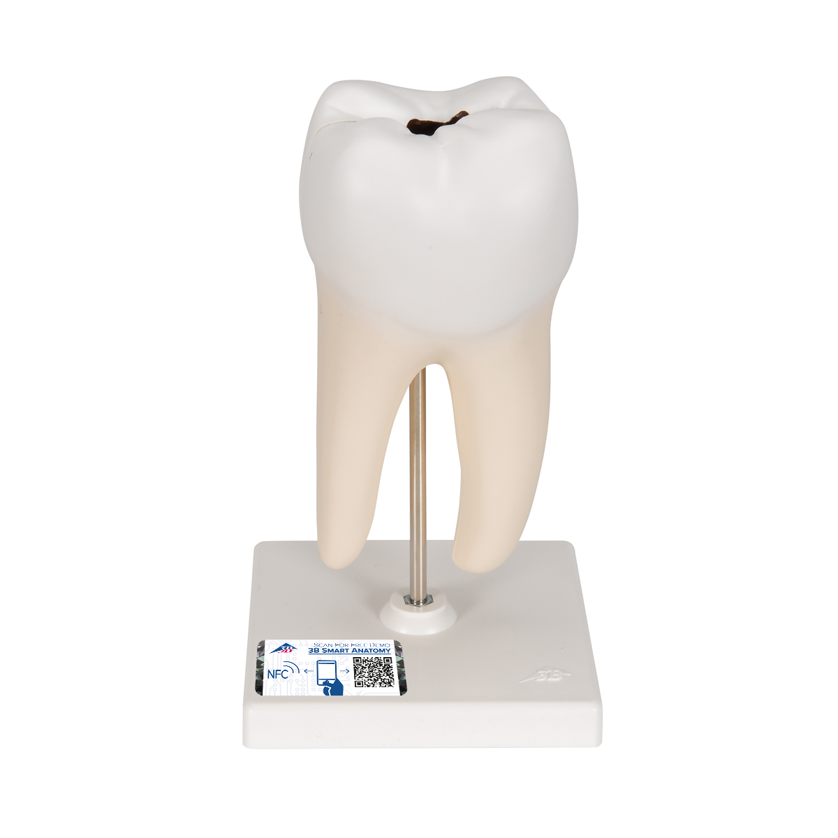 Zahn Modell Unterer Zweiwurzeliger Molar mit Karies, 2-teilig - 3B Smart Anatomy, Bestellnummer 1000243, D10/4, 3B Scientific