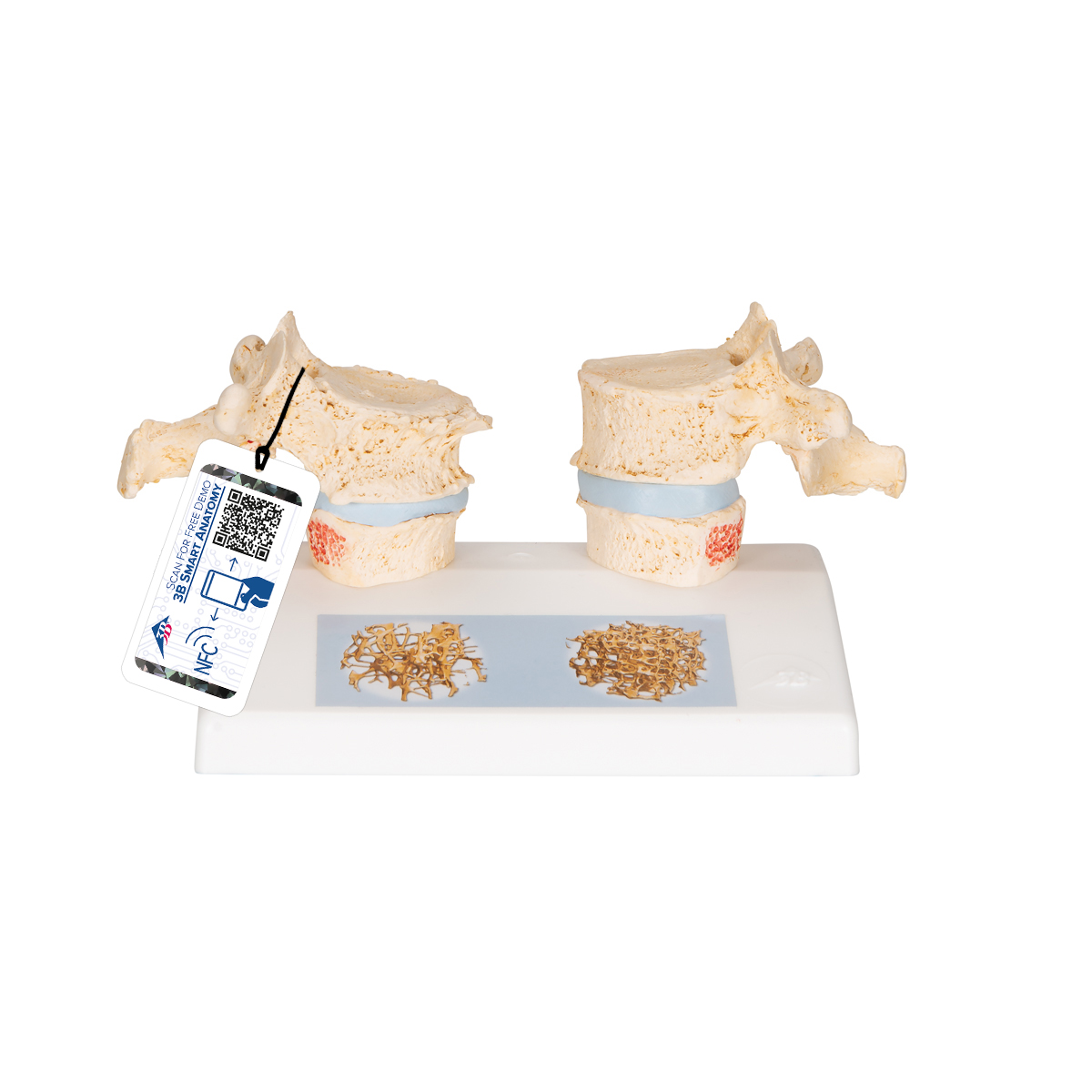 Osteoporose Modell des 11. und 12. Brustwirbels - 3B Smart Anatomy, Bestellnummer 1000182, A95, 3B Scientific