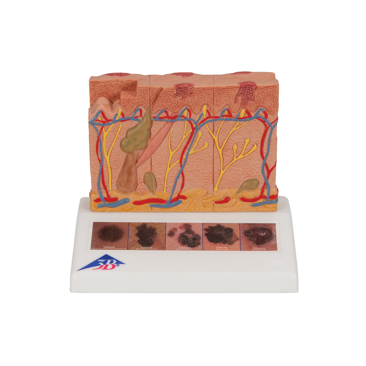 Hautkrebs Modell, 6 Stadien - 3B Smart Anatomy, Bestellnummer 1000293, J15, 3B Scientific
