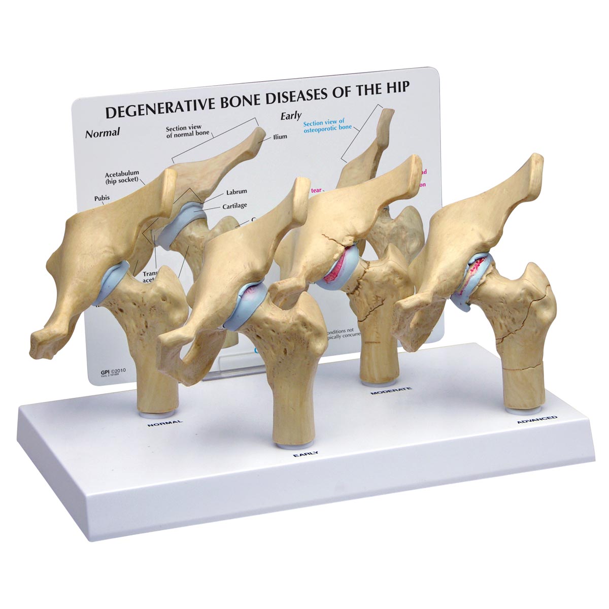 Degenerative Knochenerkrankungen des Hüftmodells in 4 Stadien, Bestellnummer 1019506, 1320, GPI Anatomicals