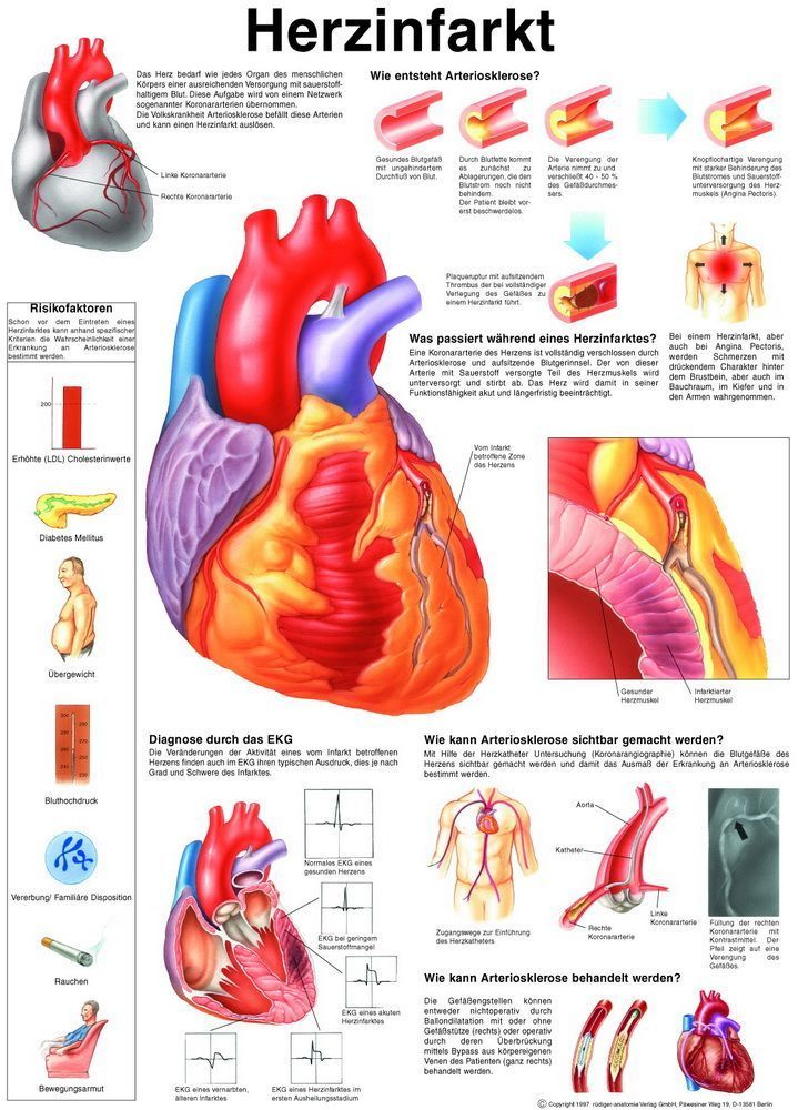 Herzinfarkt, 50x70 cm, Papier, Bestellnummer PO31, Rüdiger-Anatomie
