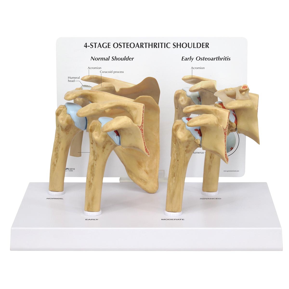 Osteoarthritis (OA) Schultermodell in 4 Stadien, Bestellnummer 1019514, 1800, GPI Anatomicals