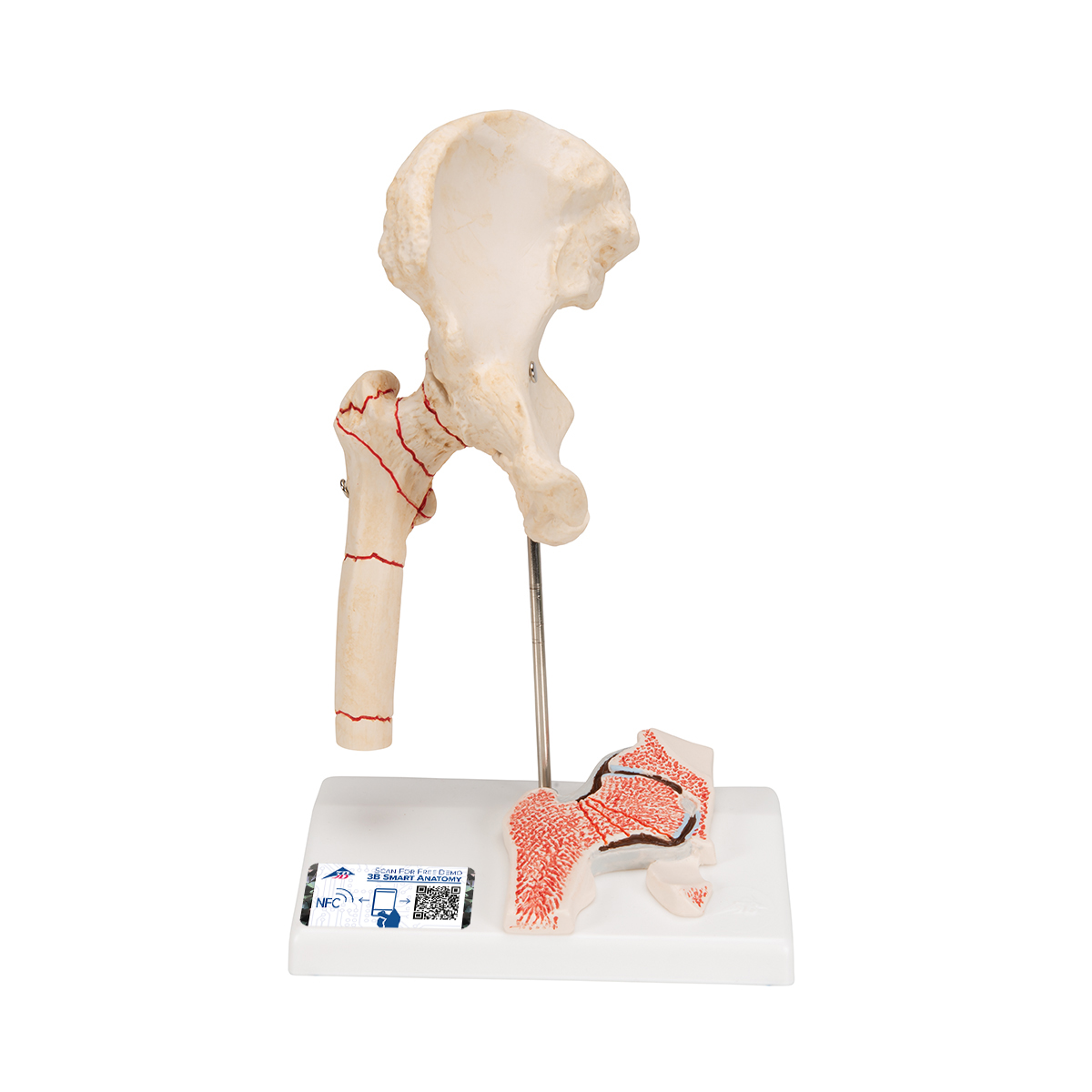 Hüftgelenkmodell mit Oberschenkelbruch & Hüftgelenkverschleiß - 3B Smart Anatomy, Bestellnummer 1000175, A88, 3B Scientific
