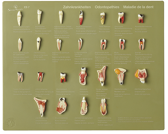 Schaukasten Zahnkrankheiten, Bestellnummer ES 7, SOMSO-Modelle
