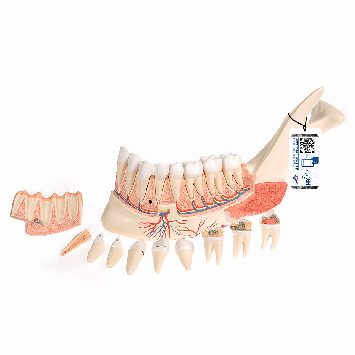 Unterkieferhälfte Modell mit 8 kariösen Zähnen, 19-teilig - 3B Smart Anatomy, Bestellnummer 1001250, VE290, 3B Scientific